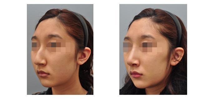 鹰钩鼻矫正术怎么样?