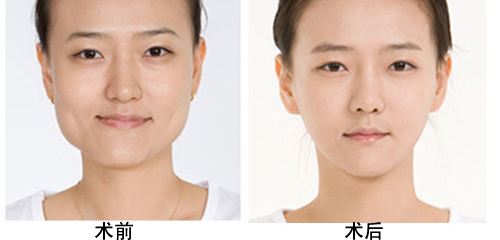 下颌角整形术后的恢复时间需要多久?