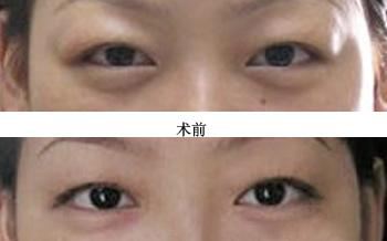 眼部吸脂术后会不会出现反弹?