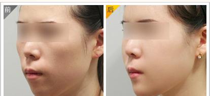 自体脂肪丰面颊的*果怎么样?