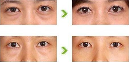 眼袋吸脂术的*果怎么样?