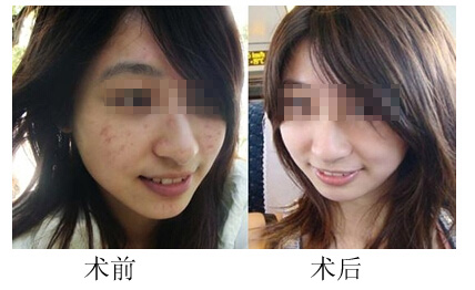 激光祛痘的*果怎么样?