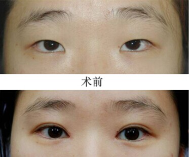 双眼皮手术如何快速消肿?