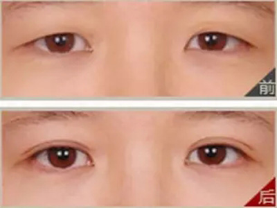 三角眼矫正手术后应注意什么?