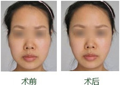 丰太阳穴术后有哪些注意事项?