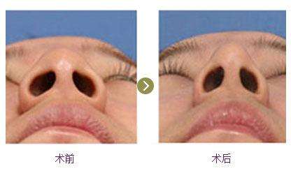 鼻翼不好看怎么办?