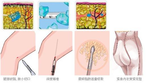 吸脂手术的优势有哪些?