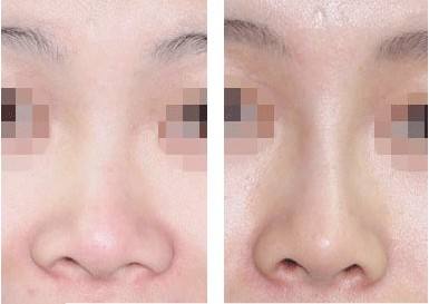 自体脂肪隆鼻后会发生移位吗?