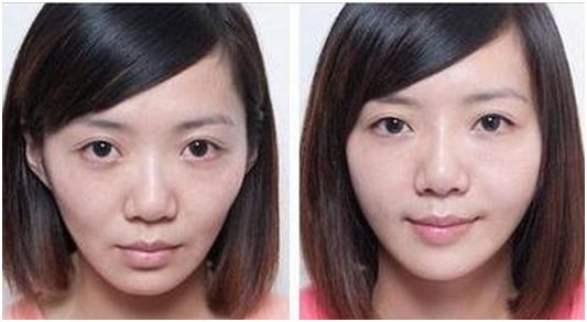 自体脂肪隆鼻后会发生移位吗?