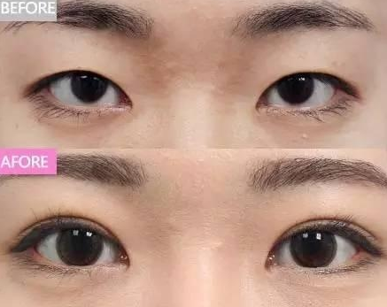 双眼皮手术失败有痕迹、大小不同该如何修复?
