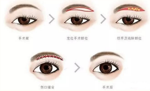 双眼皮手术失败有痕迹、大小不同该如何修复?