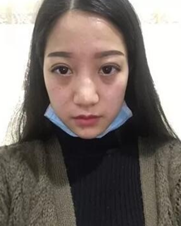长沙女孩的我隆鼻后的自述,“好险!差一点,