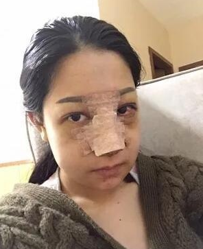 长沙女孩的我隆鼻后的自述,“好险!差一点,
