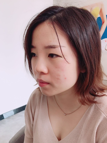 硅胶隆鼻+垫下巴 **花了4万 但我觉得很值