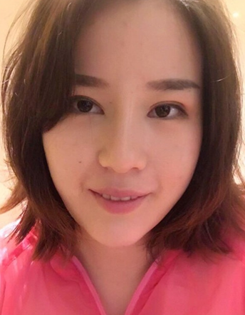 硅胶隆鼻+垫下巴 **花了4万 但我觉得很值