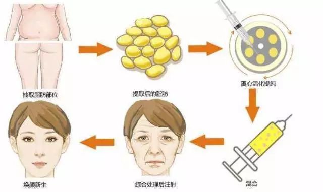微整形有哪些种类?*、玻尿酸、自体脂肪
