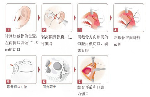 颧骨整形才用什么手术方式?怎么做*?