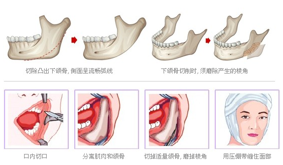 下颌角整形是怎么做的?有什么后遗症吗?