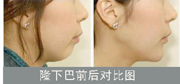 假体隆下巴是怎么做的?怎么护理*果才好?