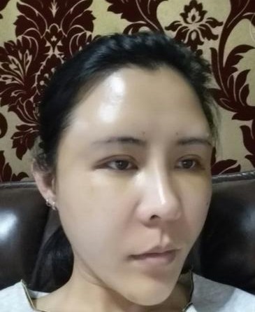 微创双眼皮+自体脂肪泪沟+太阳穴脂肪填充+自体