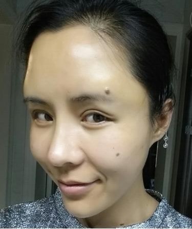 微创双眼皮+自体脂肪泪沟+太阳穴脂肪填充+自体