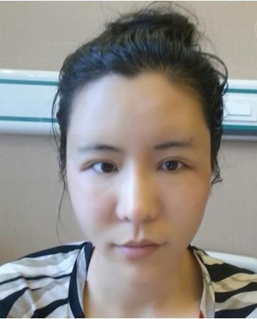 微创双眼皮+自体脂肪泪沟+太阳穴脂肪填充+自体