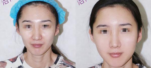 自体脂肪填充面部可能会出现的风险