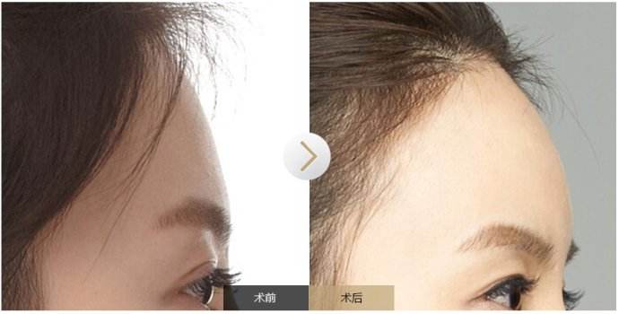 自体脂肪填充面部可能会出现的风险