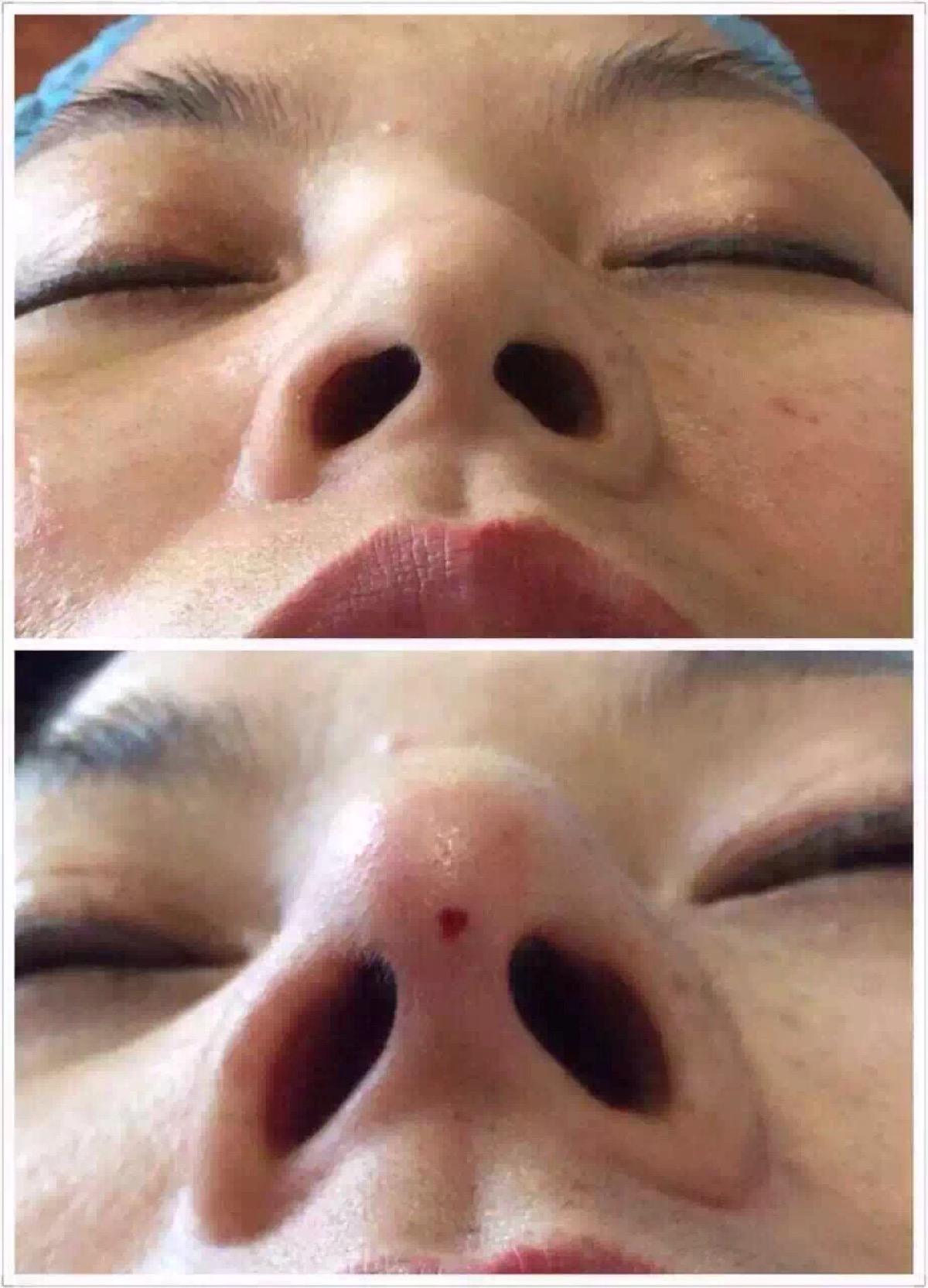 *失败多?难道做鼻子非选假体?
