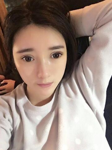 自体脂肪填充和双眼皮修复案例分享