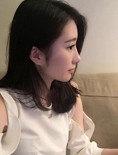 自体脂肪填充和双眼皮修复案例分享