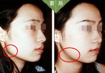下颌角整形的术后护理及风险