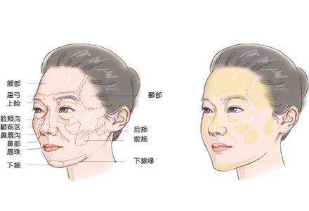 自体脂肪填充为何这么火?作用,能的*果