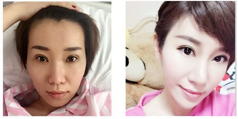 自体脂肪填充为何这么火?作用,能的*果