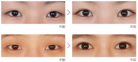 开眼角的术前术后注意事项(重点)
