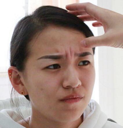 *去抬头纹眉间纹恢复过程图，真实案例分享