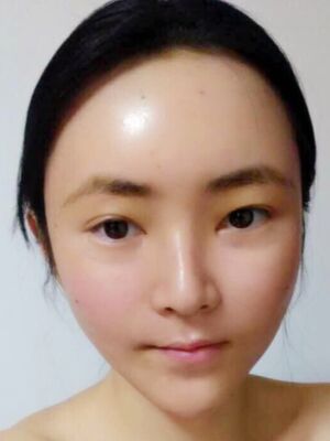 全脸脂肪填充+自体脂肪丰胸，爱美者反馈*果