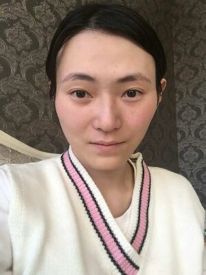 全脸脂肪填充+自体脂肪丰胸，爱美者反馈*果