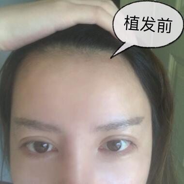 广州倍生发际线种植100天，爱美者反馈*果