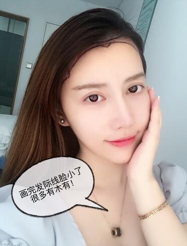 广州倍生发际线种植100天，爱美者反馈*果