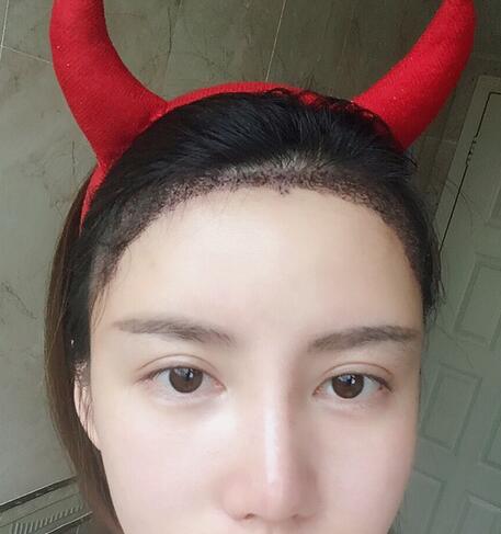 广州倍生发际线种植100天，爱美者反馈*果