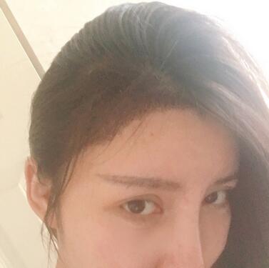 广州倍生发际线种植100天，爱美者反馈*果