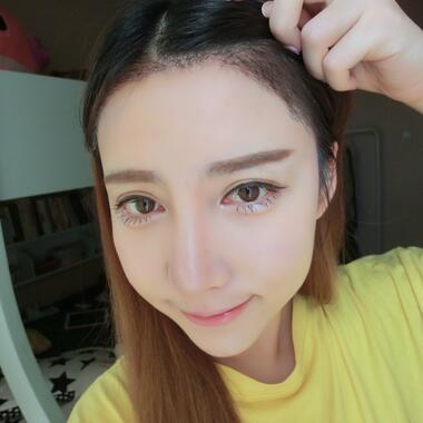 广州倍生发际线种植100天，爱美者反馈*果