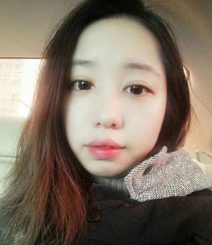 全切双眼皮，单眼皮变双眼皮的奇迹