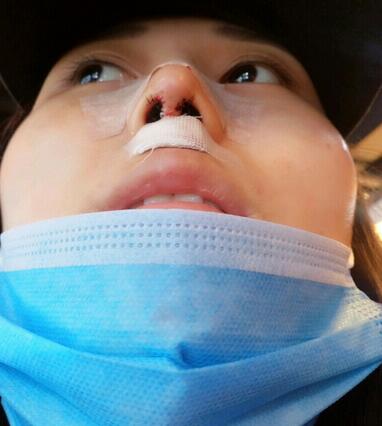鼻小柱鼻中隔延长+耳软骨鼻尖2个月，上海爱美者