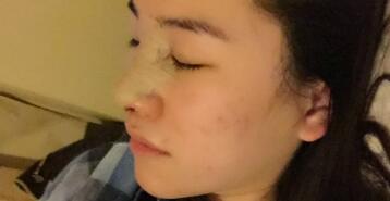 硅胶隆鼻和鼻翼缩小，活动价格15800元