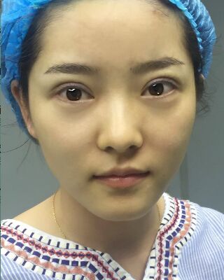 长沙希美蒋松林做双眼皮的案例反馈，价格8400元
