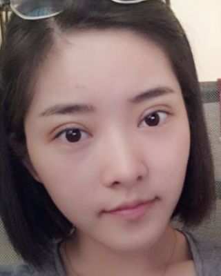 长沙希美蒋松林做双眼皮的案例反馈，价格8400元