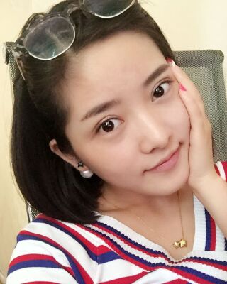 长沙希美蒋松林做双眼皮的案例反馈，价格8400元