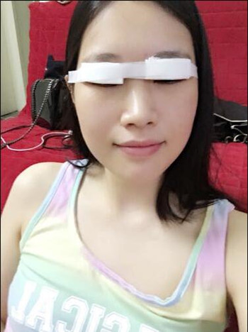做全切双眼皮,花了8000多,第三天的反馈